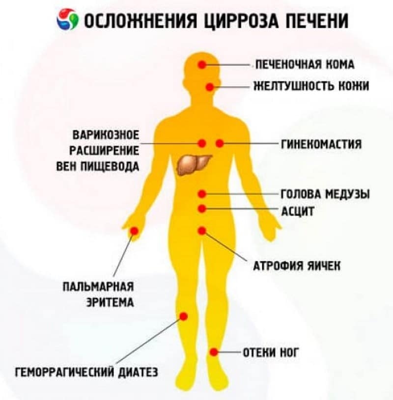 Цироз печінки: види, причини, ознаки, симптоми і лікування