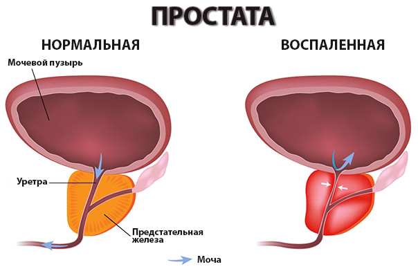 Дієта при простатиті: смачні і прості страви з корисних продуктів