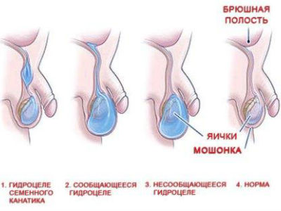 Гідроцеле: симптоми водянки яєчка і методи лікування