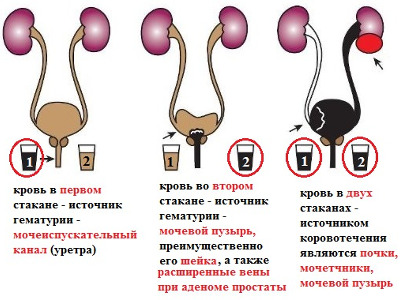 Гематурія: що це таке і яка буває