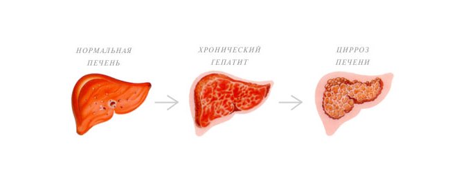 Гепатит С: які причини і лікування хвороби?