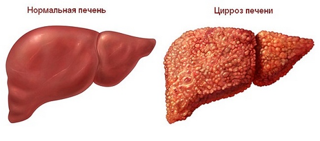 Гепатит С: які причини і лікування хвороби?