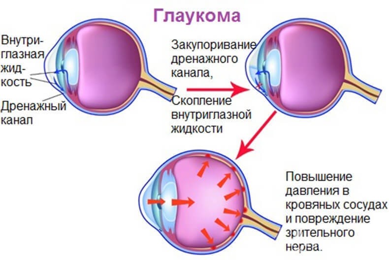 Глаукома: причини, симптоми, лікування та профілактика, фото