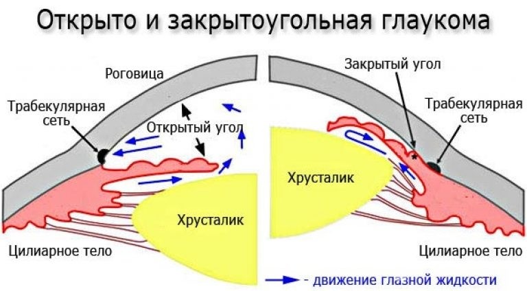 Глаукома: причини, симптоми, лікування та профілактика, фото