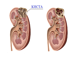 Кіста нирки: форми і прояви