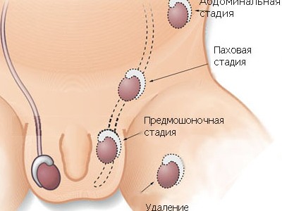 Крипторхізм: операція і особливості захворювання