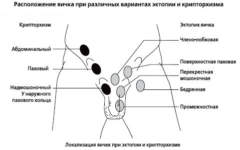 Крипторхізм яєчка: що це таке і як виникає