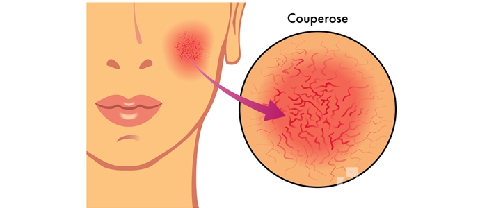 Купероз на обличчі — способи позбавлення від капілярів на обличчі
