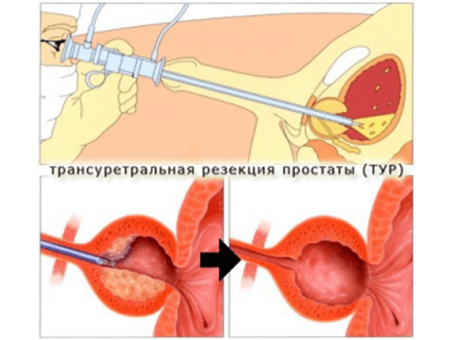 Лазерна операція з видалення аденоми простати і її позитивні і негативні наслідки