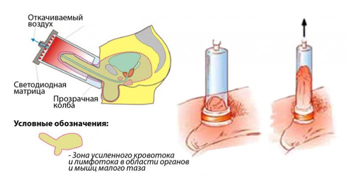 ЛОД-терапія в урології — свідчення, процедури, результативність