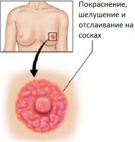 Лущиться шкіра на сосках, фото, всі причини і захворювання