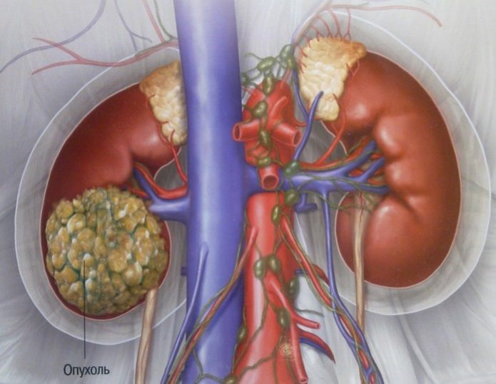 Небезпечна для життя ангиомиолипома нирок