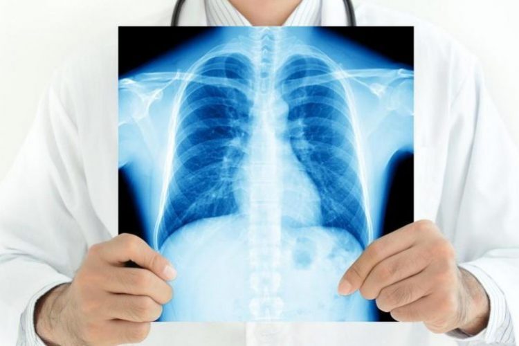 Інфільтративний туберкульоз симптоми