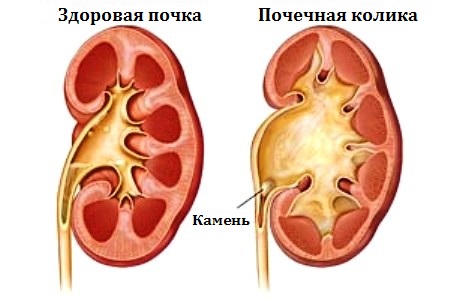 Ниркова коліка: як подолати біль