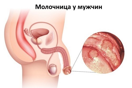 Інкубаційний період молочниці у жінок або мужни