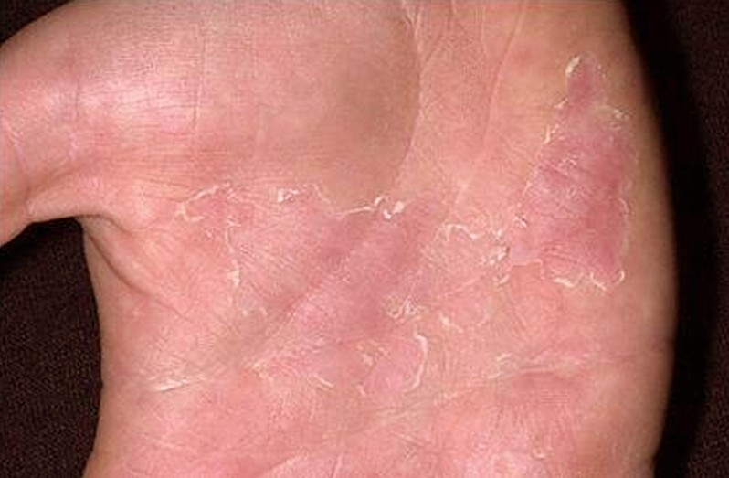 Облазить шкіра на долонях – причини з фото і лікування