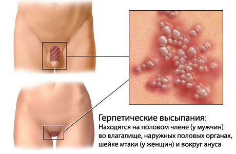 Ознаки венерологічних захворювань у чоловіків