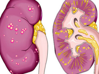 Пієлонефрит: що це таке, чим небезпечний і основні форми захворювання