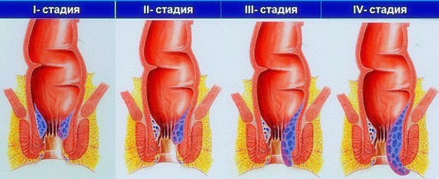 Післяопераційний період після видалення геморою і його тривалість