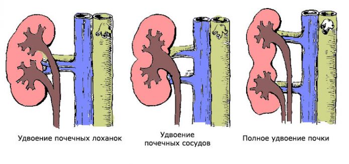 Подвоєння нирок у дітей і дорослих: небезпечна патологія або особливість розвитку?