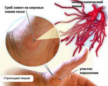 Різновиди лишай у людини і їх характерні ознаки