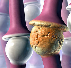 Ревматоїдний артрит: причини, симптоми, лікування, дієта, наслідки