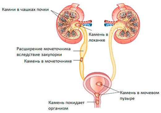 Сечокам’яна хвороба у чоловіків – причини і лікування