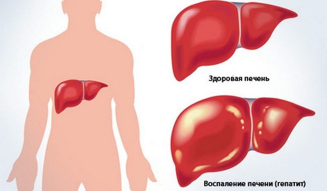 Симптоми, ознаки та особливості захворювань печінки
