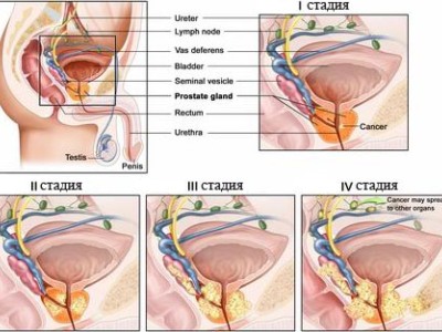 Стадії раку передміхурової залози: опис і симптоматика