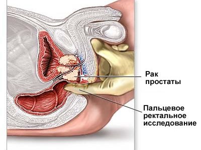 Стадії раку передміхурової залози: опис і симптоматика