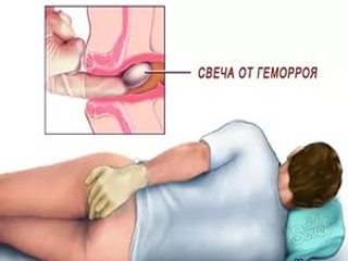 Свічки при геморої: методи лікування захворювання, особливості застосування супозиторіїв