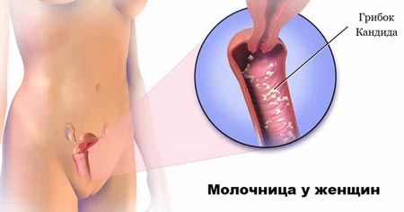 Свербіж в ділянці клітора і статевих губ – всі причини і лікування