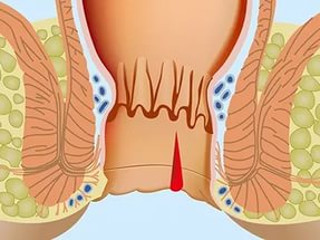 Тріщина анального отвору: причини, клінічна картина