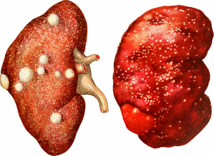 Туберкульоз нирок
