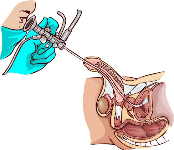 Уретроскопія у чоловіків: показання, особливості, наслідки