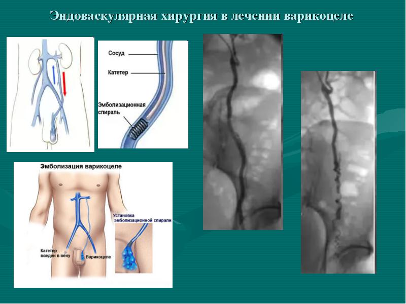 Варикоцеле: що це таке, визначення та характеристики