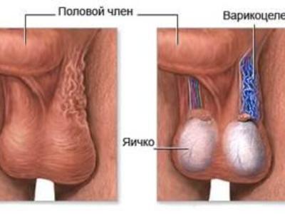 Варикоцеле зліва: опис захворювання та стадії розвитку