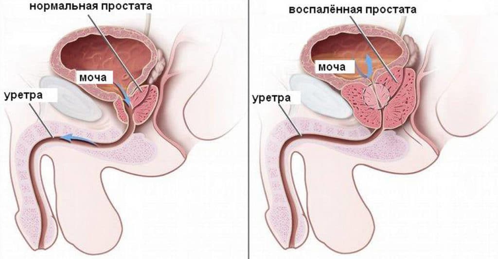 Виділення при простатиті у чоловіків – види і чим лікувати