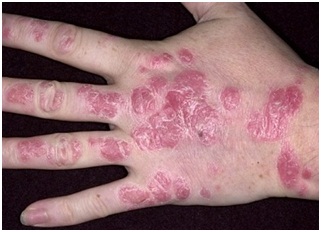 Висип на пальцях рук: причини появи та можливе лікування