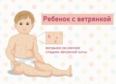 Висип на тілі дитини: причини і лікування
