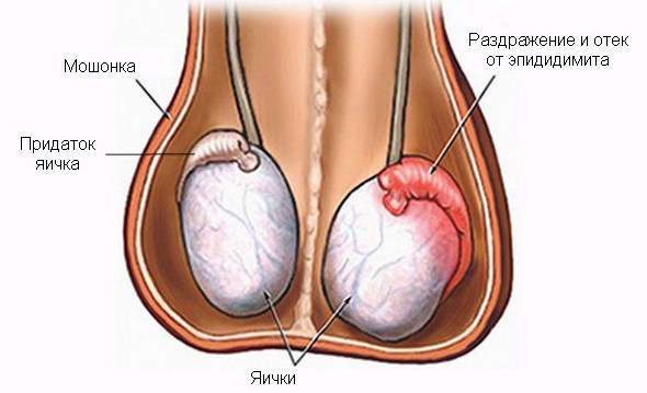 Запалення яєчка у чоловіків (орхоэпидидимит) – 4 причини, фото