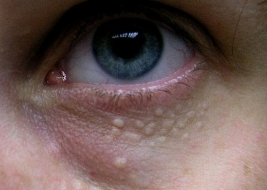 Жировик під очима і в них — 10 причин виникнення та правильне лікування