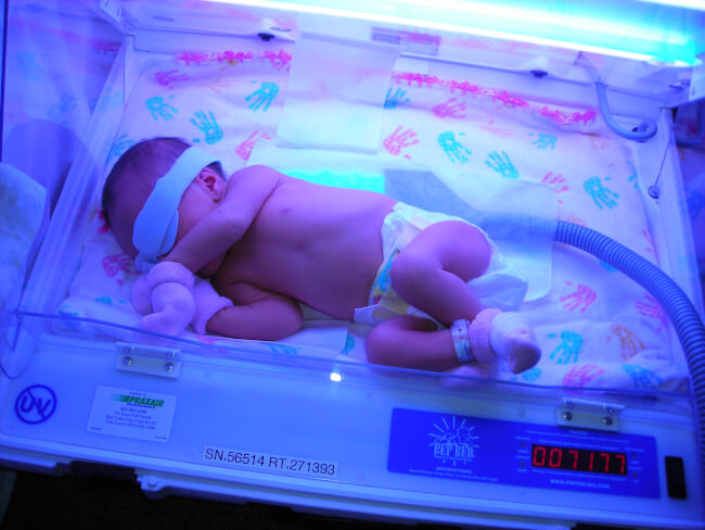 Жовтянка новонароджених: причини її виникнення та надійні способи боротьби
