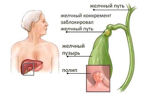 11 причин папілом в жовчному міхурі — як від них позбутися?