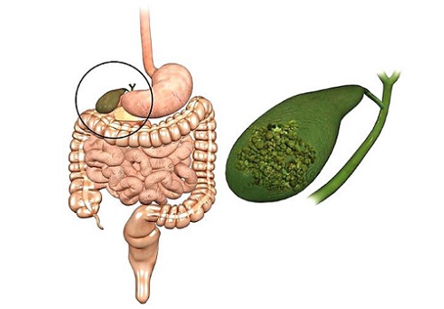 11 причин папілом в жовчному міхурі — як від них позбутися?