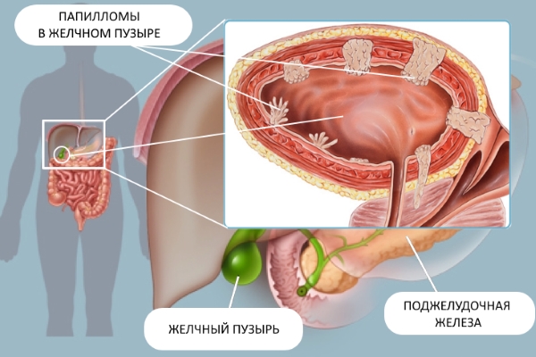 11 причин папілом в жовчному міхурі — як від них позбутися?