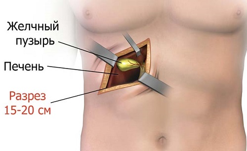 11 причин папілом в жовчному міхурі — як від них позбутися?