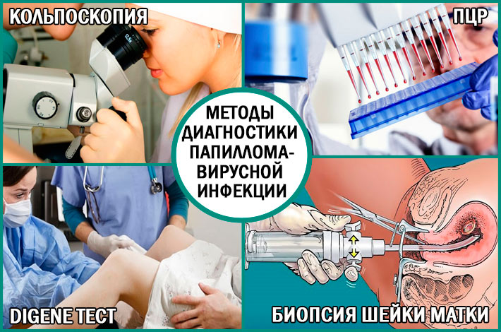 13 причин вірусу папіломи людини типу 21 — лікування та діагностика
