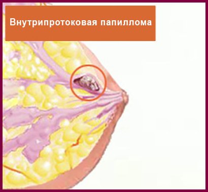 13 причин внутрішньопротокова папіломи молочної залози — як проходить видалення?