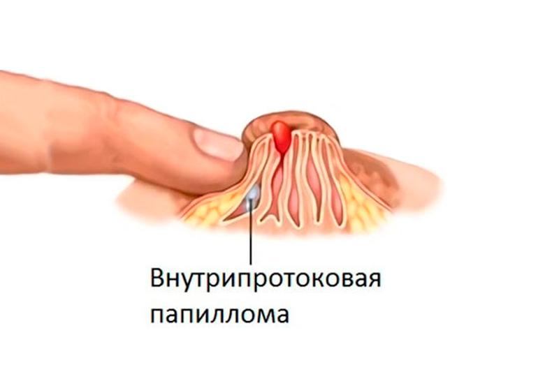 13 причин внутрішньопротокова папіломи молочної залози — як проходить видалення?